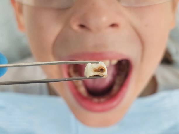 Best Emergency Tooth Extraction in Gonzales, TX